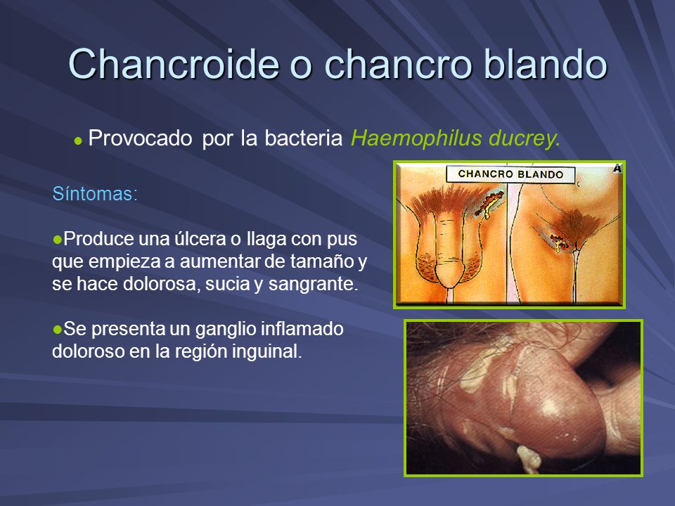 Chancro blando tratamiento y sintomas